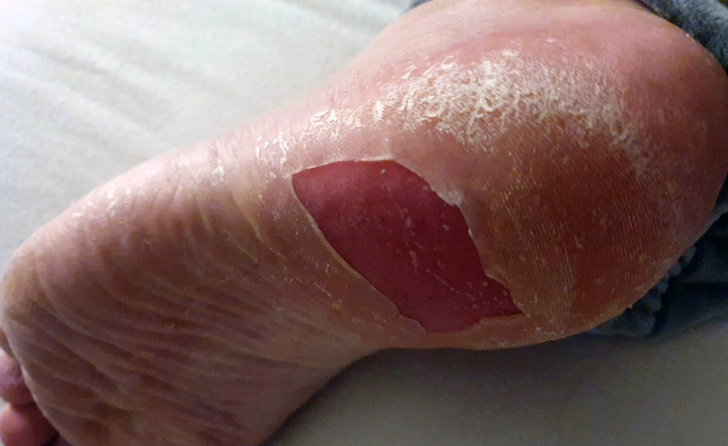 Voorbeeld van Epidermolysis Bullosa